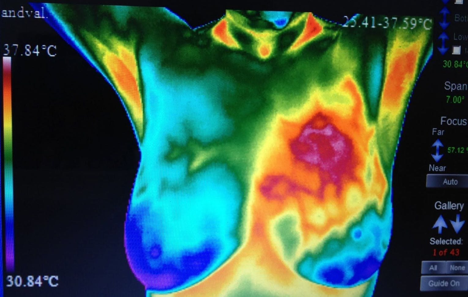 Thermogram Breasts